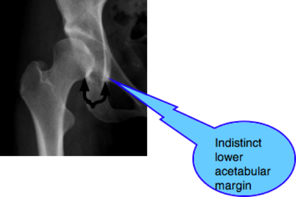 Spot x-ray showing the indistinct margin in developmental hip dysplasia.