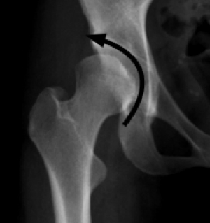 Spot x-ray showing small socket.