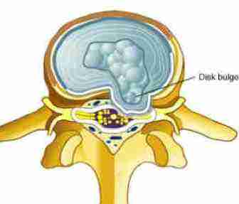 Bulging disc anatomy of the lumbar spine.