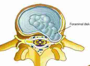 disk slipped foraminal herniation sneeze