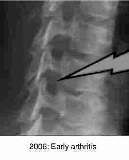 Early foraminal encroachment arthritis. Early foraminal encroachment arthritis.