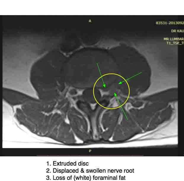 Femoral nerve damage causes severe pain in the upper anterior thigh.