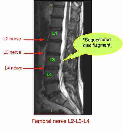 Lateral disc herniation creates something of a dilemma for the DC.