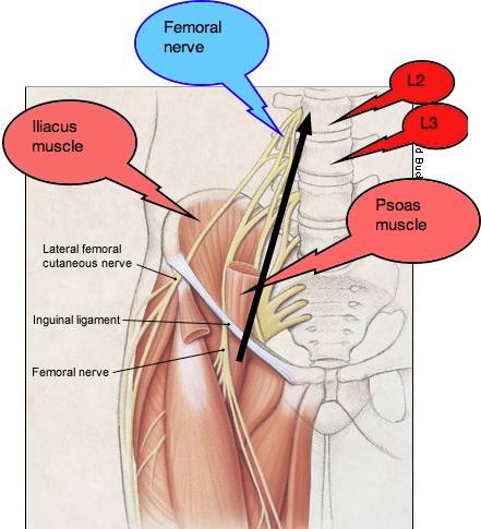 X-ray revealing how hip pain radiates to the back following the femoral nerve.