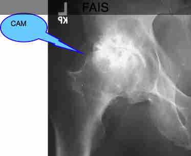 Femoro acetabular impingement syndrome causes stiffness in young hips