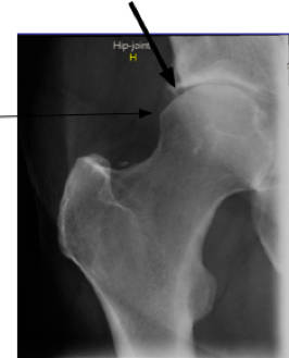 Xray mixed FAIS groin pain