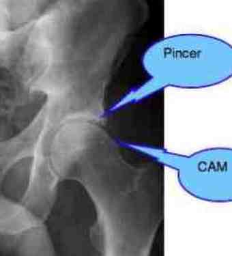 X-ray showing mixed pincer and cam deformities of FAIS. X-ray showing mixed pincer and cam deformities of FAIS.