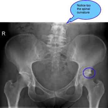 X-ray of the whole pelvis showing the pincer of femoro acetabular impingement syndrome. X-ray of the whole pelvis showing the pincer of femoro acetabular impingement syndrome.