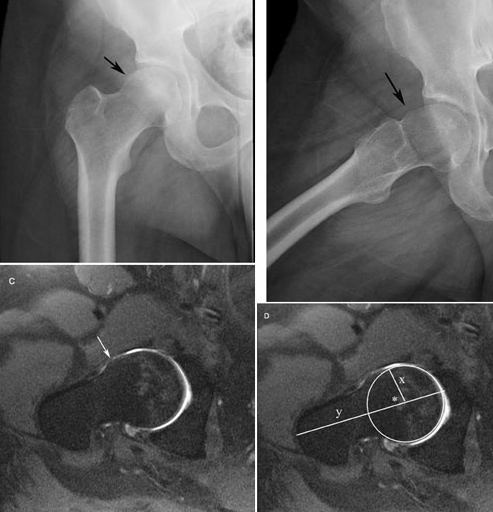 X-ray and MRI showing a CAM deformity. X-ray and MRI showing a CAM deformity.
