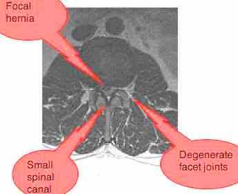 A focal hernia seen on a lumbar MRI. A focal hernia seen on a lumbar MRI.