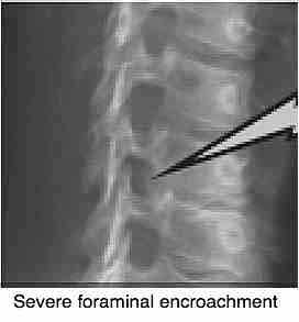 Oblique x-ray showing foraminal encroachment after whiplash type injury. Oblique x-ray showing foraminal encroachment after whiplash type injury.