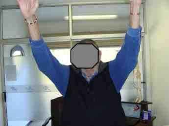 Frozen shoulder after treatment. Frozen shoulder after treatment.