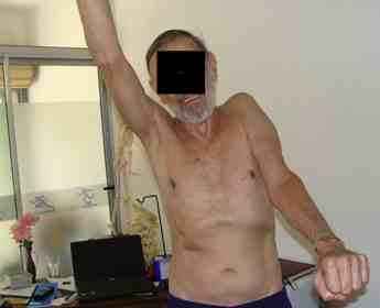 Frozen shoulder is very debilitating. Frozen shoulder is very debilitating.