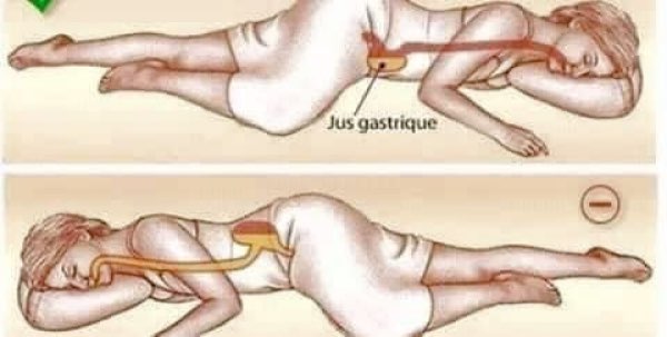 Location of the gastric juice while side-lying at night.