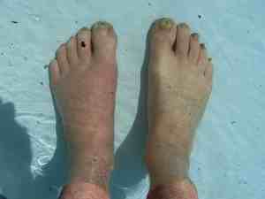 Gout cold water exercise.