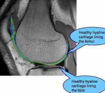 Scan showing healthy knee cartilage. Scan showing healthy knee cartilage.