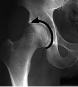 The normal spot hip x-ray showing the full circle of the head of the femur.