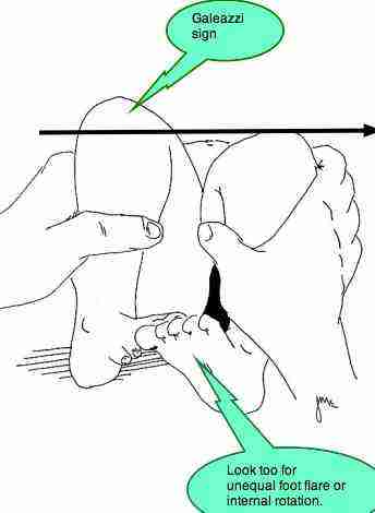Colic chiropractic should also include a brief examination of the hip joint using the test of Galeazzi, especially if there's a family history of dysplasia. Colic chiropractic should also include a brief examination of the hip joint using the test of Galeazzi, especially if there's a family history of dysplasia.