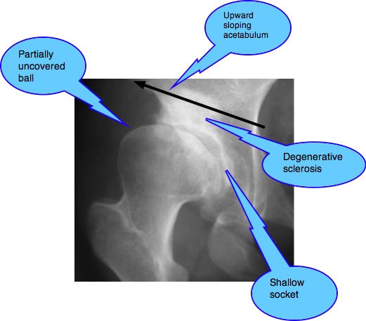 X-ray of hip arthritis showing the sloping roof.