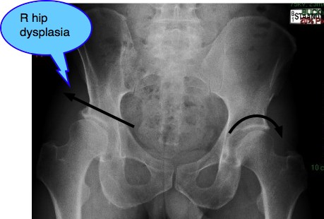 X-ray of the pelvis comparing normal and hip dysplasia.