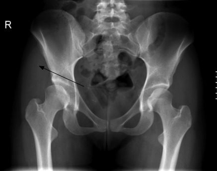 Hip dysplasia illustrating the sloping roof.