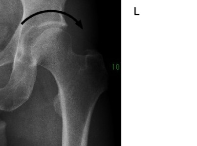 X-ray of normal hip L of patient with R hip dysplasia