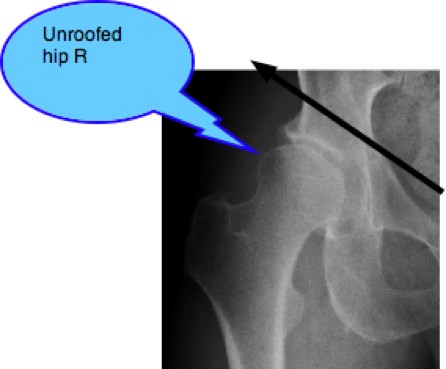 X-ray showing R hip dysplasia Mr P.