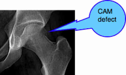 Femoro acetabular impingement syndrome of the hip.