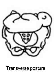 Graphic showing inutero position that leads to hip dysplasia.