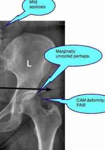 Spot view of the hypermobile CAM type of FAIS deformity. Spot view of the hypermobile CAM type of FAIS deformity.