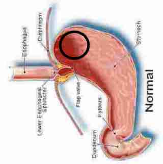 Indigestion lying on right side. Indigestion lying on right side.