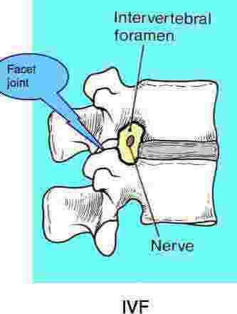 The intervertebral foramen in the lumbar spine.