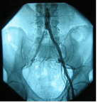 Intermittent claudication