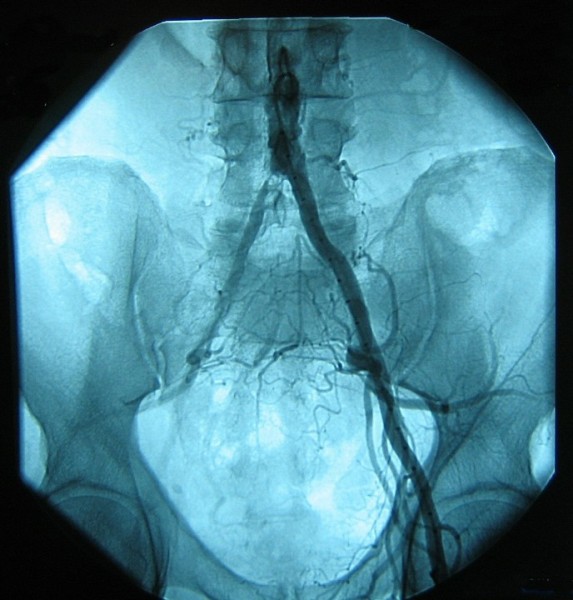 atherosclerosis of leg with intermittent claudication icd 10