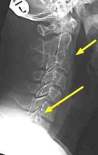 Lateral cervical spine.