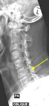 Left oblique of the cervical spine.