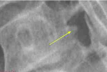 Spot view of the left cervical oblique.
