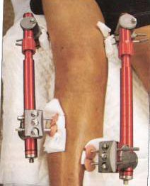 Orthotic distraction device for the arthritic knee. Orthotic distraction device for the arthritic knee.