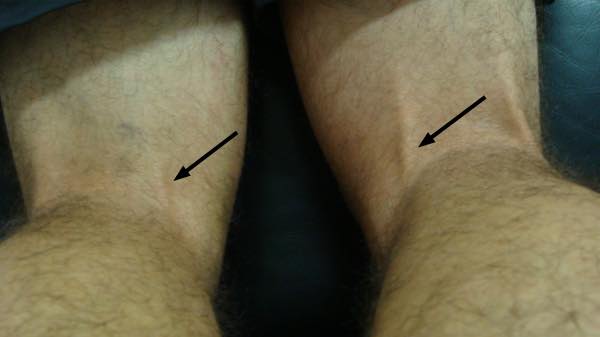 L5 deep tendon reflex with tendon marked. L5 deep tendon reflex with tendon marked.