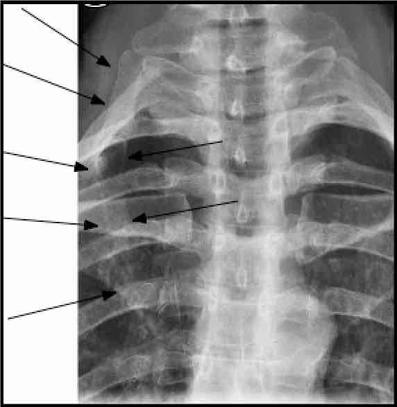 Large cervical rib on x-ray. Large cervical rib on x-ray.