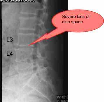 Lateral lumbar x-ray in a femoral nerve case file. Lateral lumbar x-ray in a femoral nerve case file.