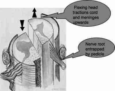 Lhermitte sign in the Flip test.