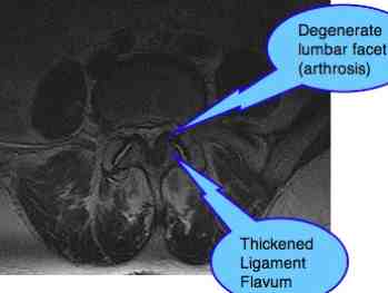 Lumbar Facet Arthropathy Spondylolysthesis causes lower back and leg pain.