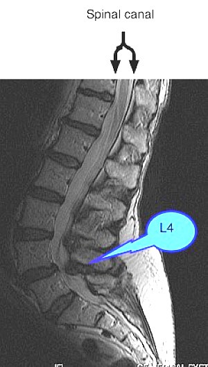 Spinal stenosis exercise helps to keep the joints gliding smoothly.