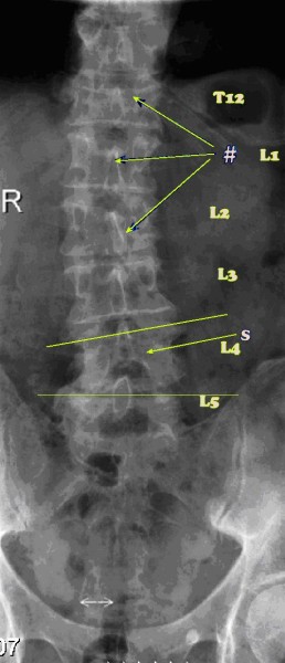 Lumbar fractures seen on an AP x-ray.