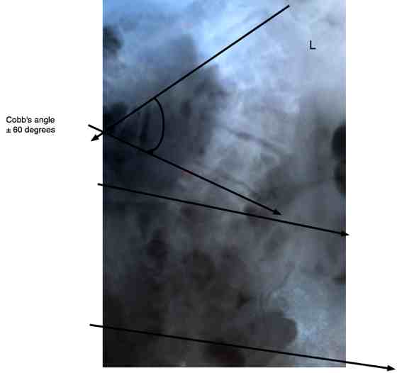 Cobb's angle is used to measure scoliosis. Cobb's angle is used to measure scoliosis.