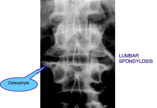 Lumbar spondylosis casefile is a complex patient with back, groin and