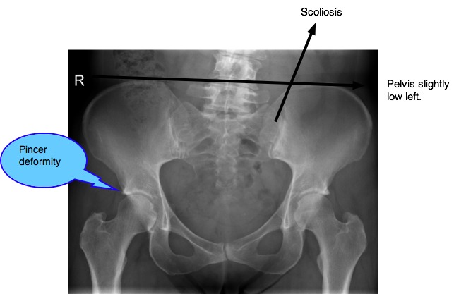 Lumbar spondylosis casefile is complex with back, groin and thigh pain