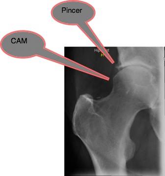 Spot x-ray showing mixed FAIS. Spot x-ray showing mixed FAIS.
