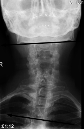 Neck pain anatomy casefile tells how x-rays can be very misleading.